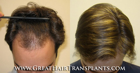 low cost hair transplant