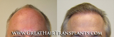 hair restoration