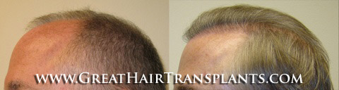 hair transplant surgery