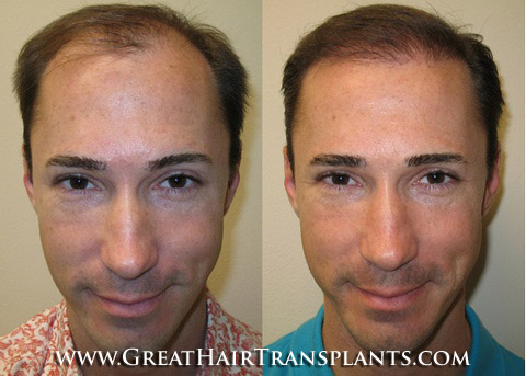 hair transplantations