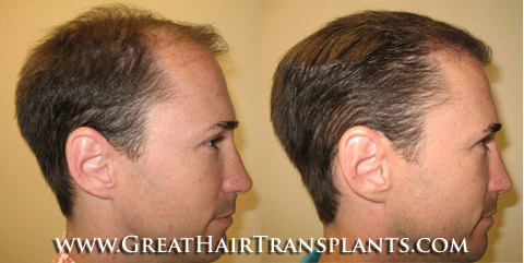 hair transplant cost