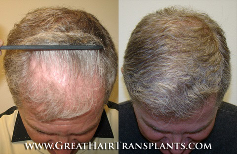 how much does a hair transplant cost