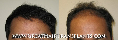 hair transplant cost