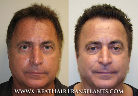 hair transplant