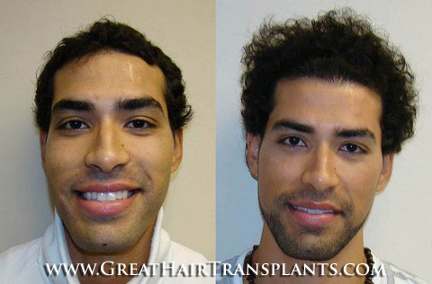 hair surgeries