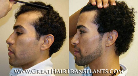 hair restoration