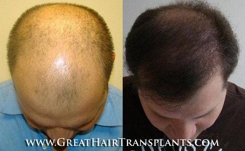 restoration of hair