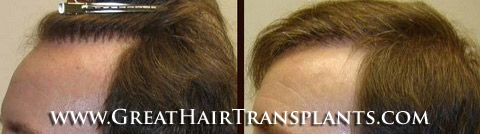 low cost hair transplant