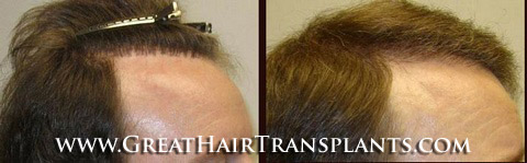 hair transplant procedure