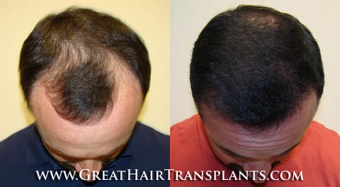 hair restoration