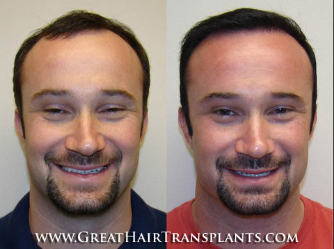 hair transplant surgery