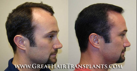 hair transplant surgery