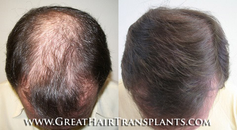 how much does a hair transplant cost