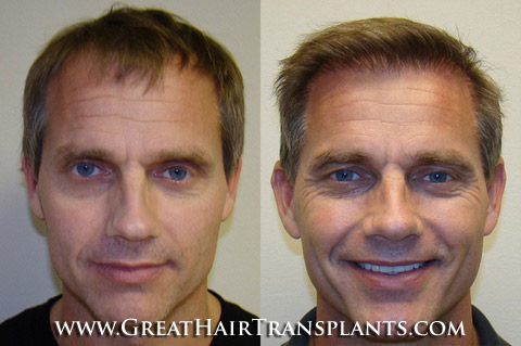 hair restoration