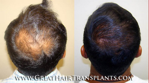 affordable hair transplants