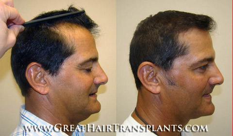 hair transplant surgery