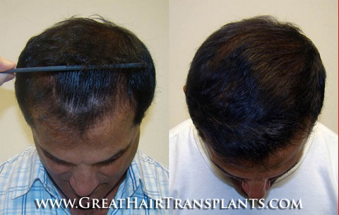 hair implant