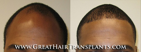 hair transplant cost