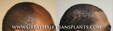 hair restoration