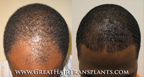 hair restoration