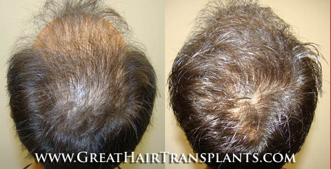 restoration of hair