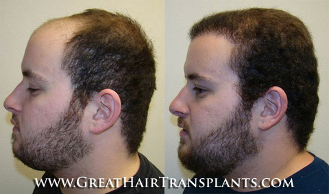 low cost hair transplant