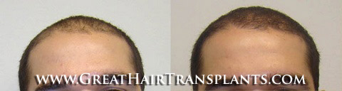 low cost hair transplant