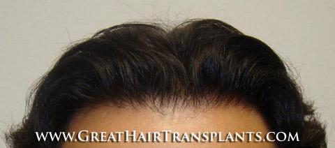 hair transplant clinics