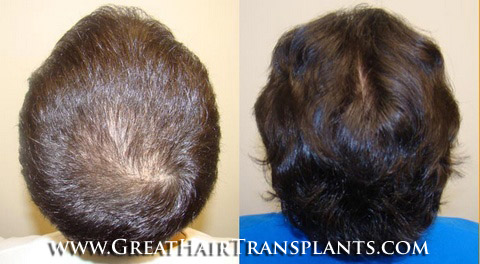 hair transplant