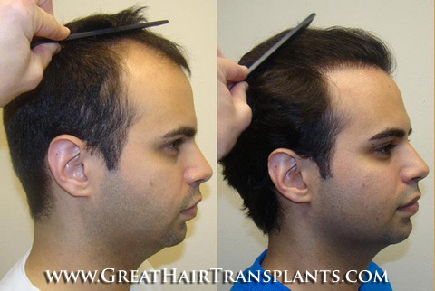 surgical hair restoration