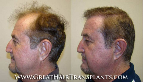 how much does a hair transplant cost