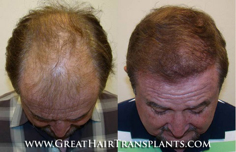 follicular unit extraction