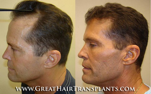 hair loss treatments