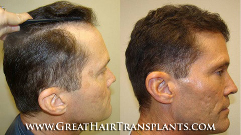 hair implant