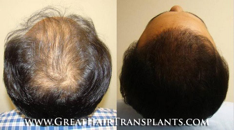 hair restoration