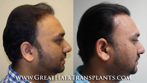 hair loss treatment