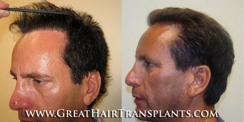 how much does a hair transplant cost