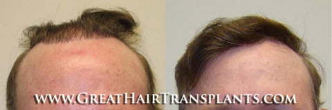 hair transplants