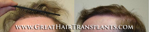 hair system