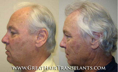 how much does a hair transplant cost