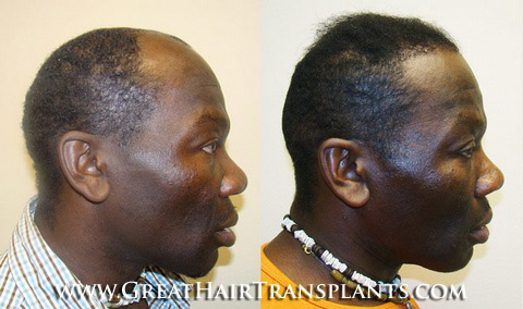 hair implantation