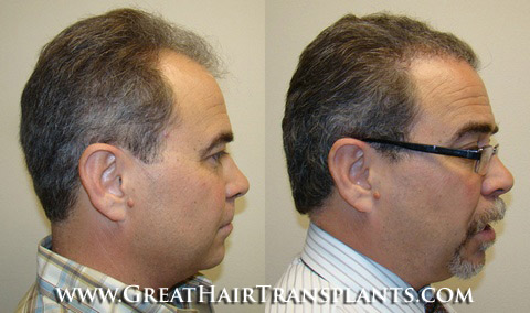 hair transplant cost