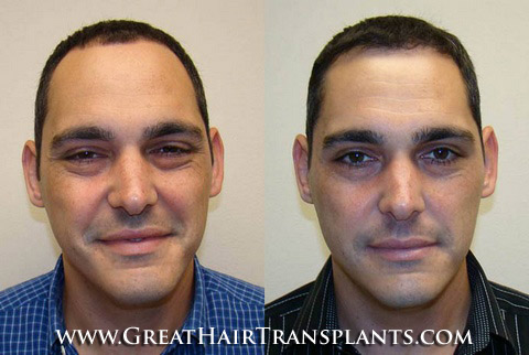 hair transplantation