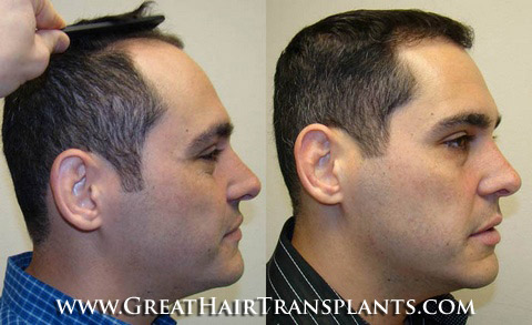 how much does a hair transplant cost