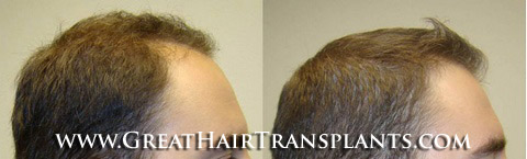 hair transplants