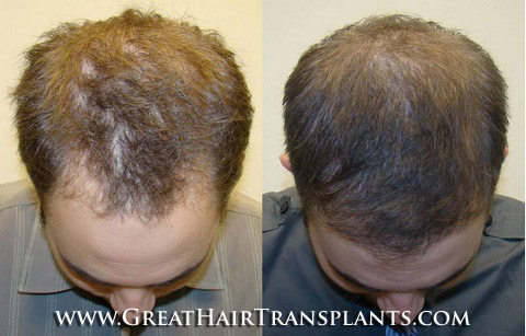 hair transplant