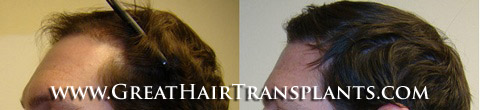 low cost hair transplant