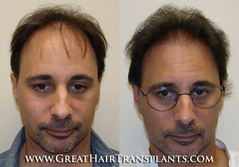 hair transplant