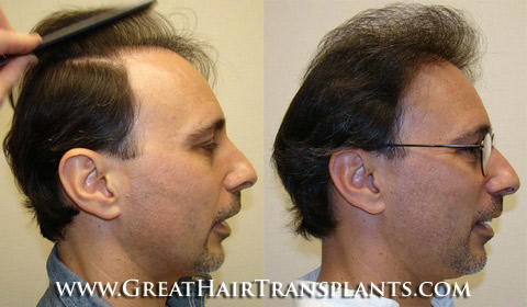 hair transplant surgery