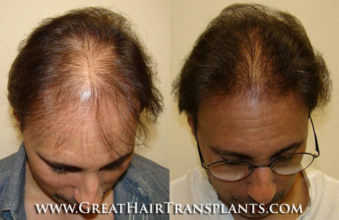 hair transplant